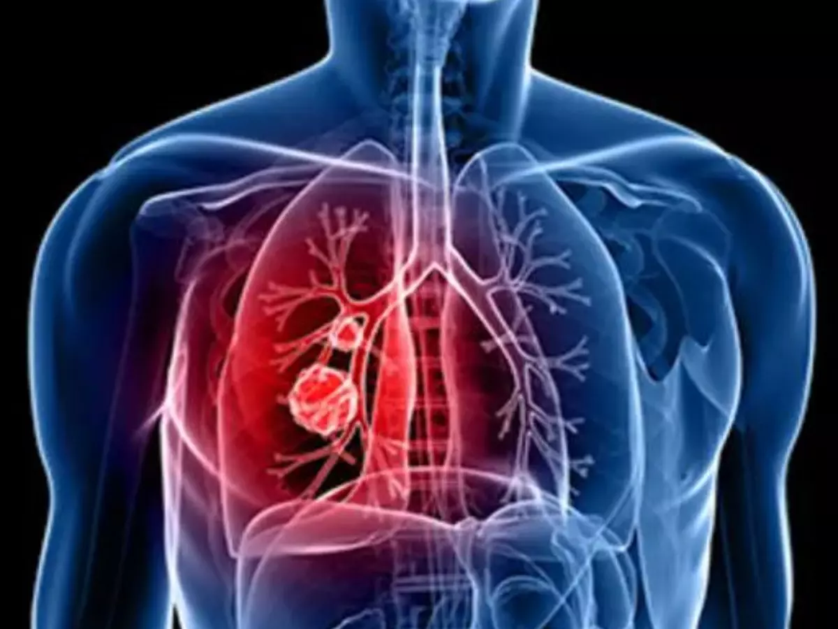 World Lung Cancer Day 2024: 6 subtle signs you need to watch out for