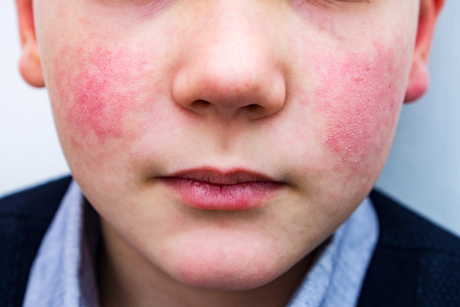 ‘Slapped cheek’ rash-causing virus on the rise among kids, CDC warns